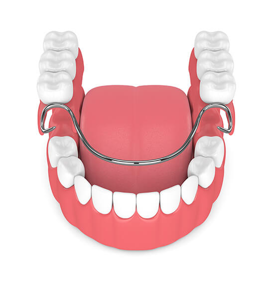 partial-denture